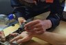В Пензе спасатели помогли женщине снять кольцо со сломанного пальца